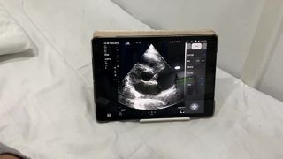 مسبار الموجات فوق الصوتية اللاسلكي ذو الرأس المزدوج للقلب وPOCUS