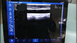 الماسح الضوئي الخطي بالموجات فوق الصوتية اللاسلكي للتوجيه الدقيق